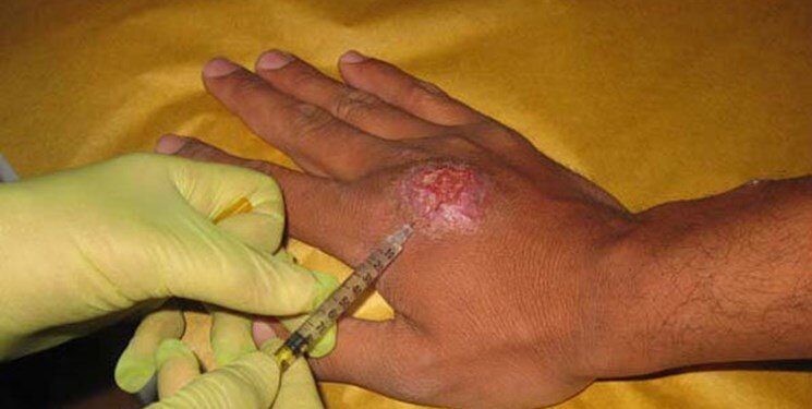 شیوع سالک در فصول گرم از مشکلات مهم شهروندان منطقه کاشان