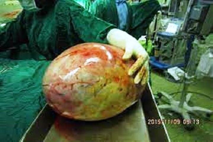 خارج کردن توده ٦ کیلویی در بیمارستان تامین اجتماعی سنندج
