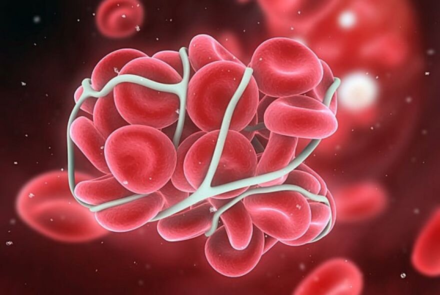 توزیع داروی گرانقیمت بیماران هموفیلی معطل سازمان غذا و دارو