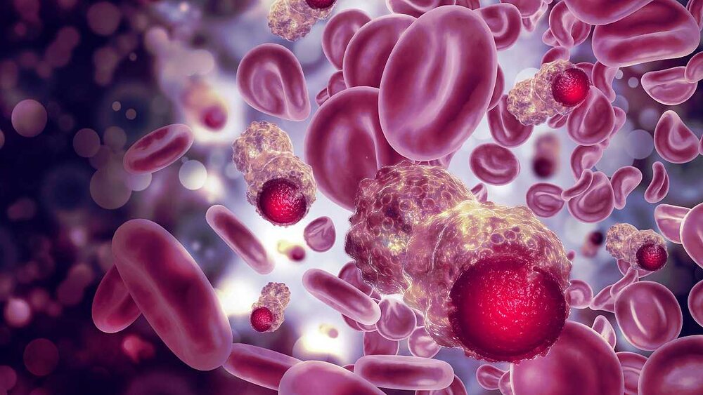 دانشمندان راهی برای تشخیص راحت‌تر سرطان روده بزرگ پیدا کردند
