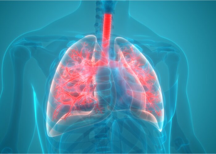 افزایش بروز «آمپیم» به دنبال عفونت‌های تنفسی