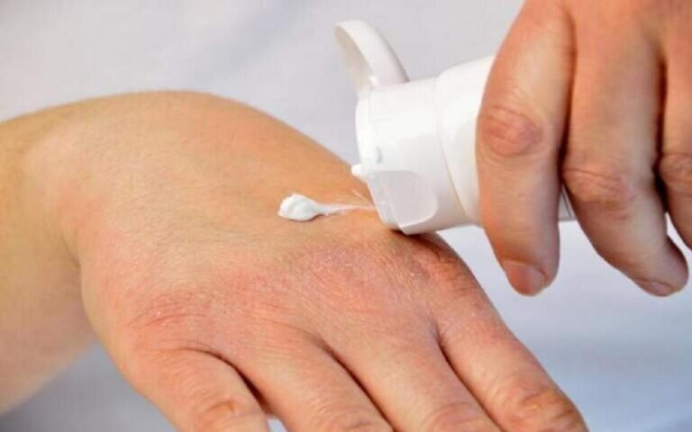 آکنه یا جوش‌های غرور چیست؟ 