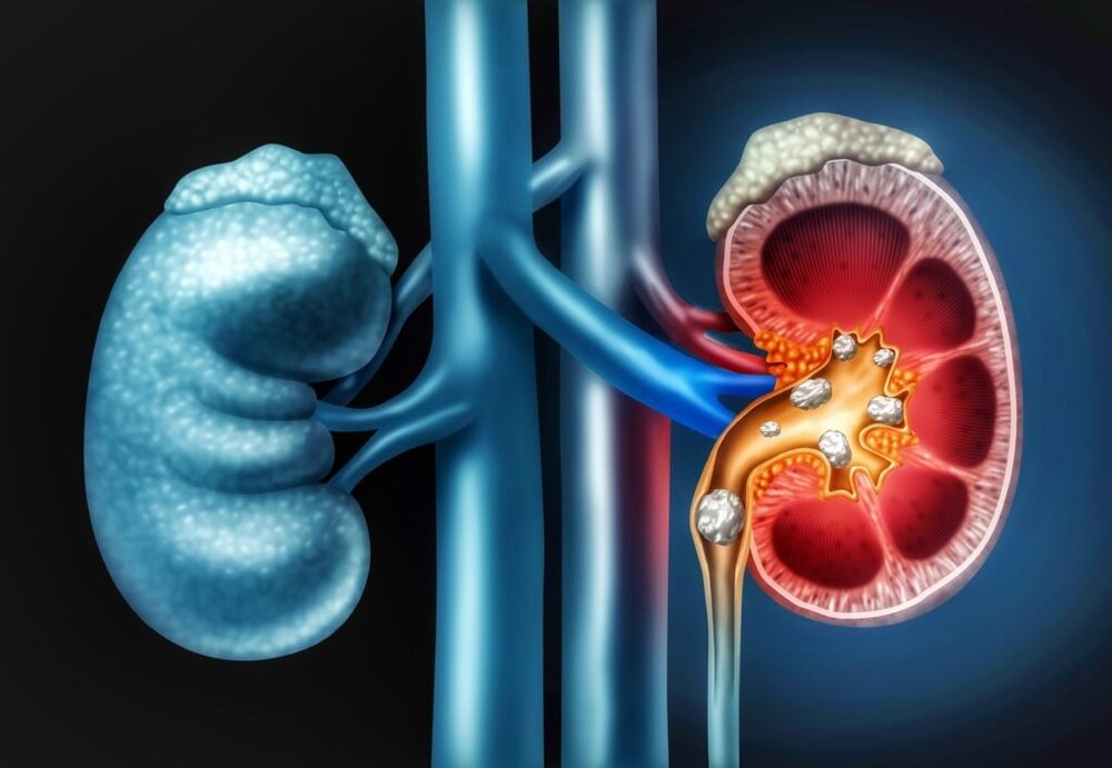 بیماری‌های کلیوی؛ آغاز تخریب بی‌سروصدای بدن