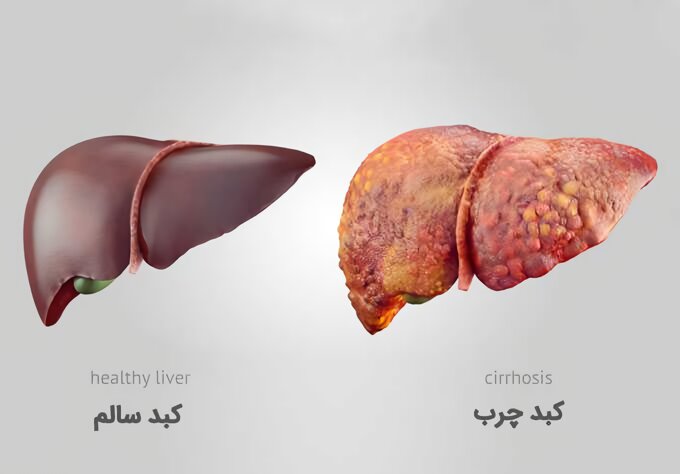 کبد چرب چیست و چطور آن را بشناسیم؟