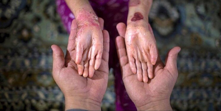 وزارت بهداشت  ۷۰۰ روز به درخواست بیماران پروانه‌ای بی‌توجه بوده است