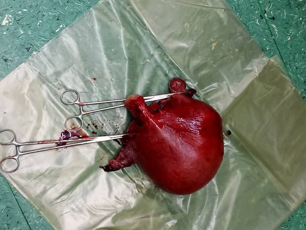 خارج کردن توده شکمی ۳ کیلوگرمی در بیمارستان تامین‌اجتماعی ۲۹ بهمن تبریز