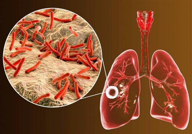 شایع‌ترین علامت ابتلا به بیماری سل سرفه پایدار به مدت دو هفته است