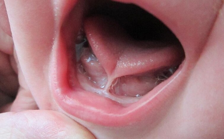 تجارت پررونق بریدن زبان نوزادان در آمریکا