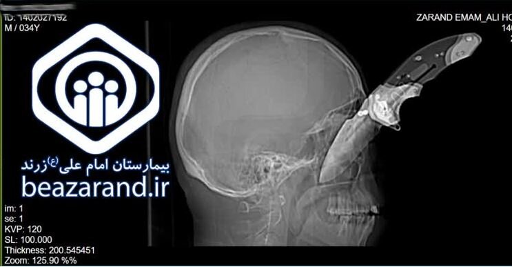 جراحی موفق چشم در بیمارستان تامین‌اجتماعی امام علی (ع) زرند