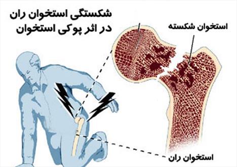 پوکی استخوان را چقدر می‌شناسید؟