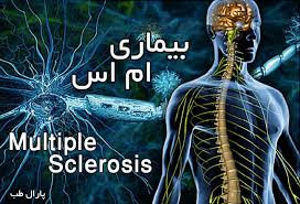 استرس ناشی از بیکاری و تشدید بیماری ام اس