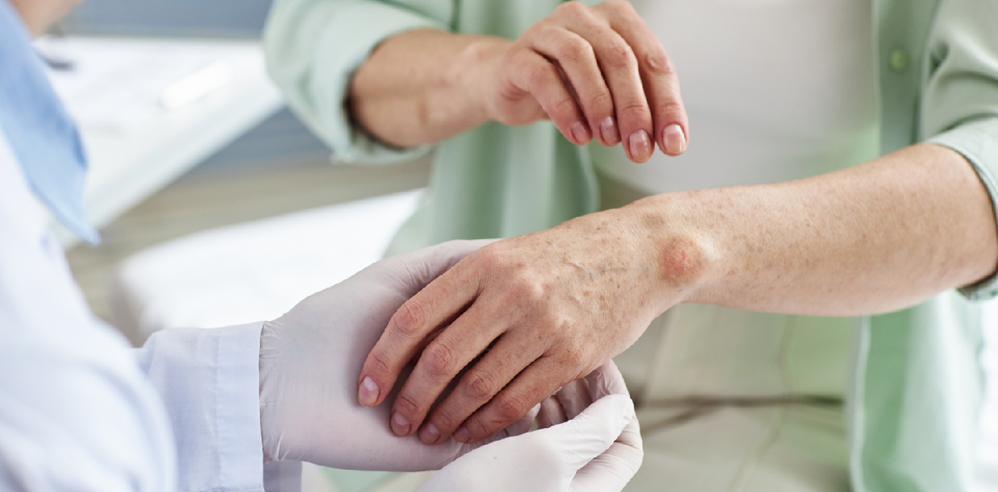 دانشمندان در آستانه‌ی مهار لوپوس