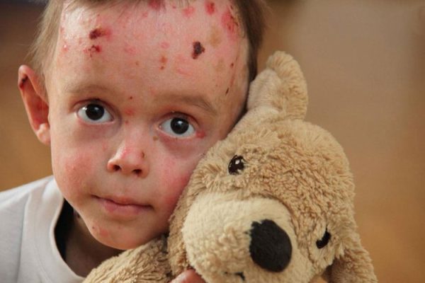 درخواست «خانه ای‌بی» از بنیاد بیماری‌های خاص: فهرست خدمات قابل ارایه به بیماران ای‌بی را اعلام کنید