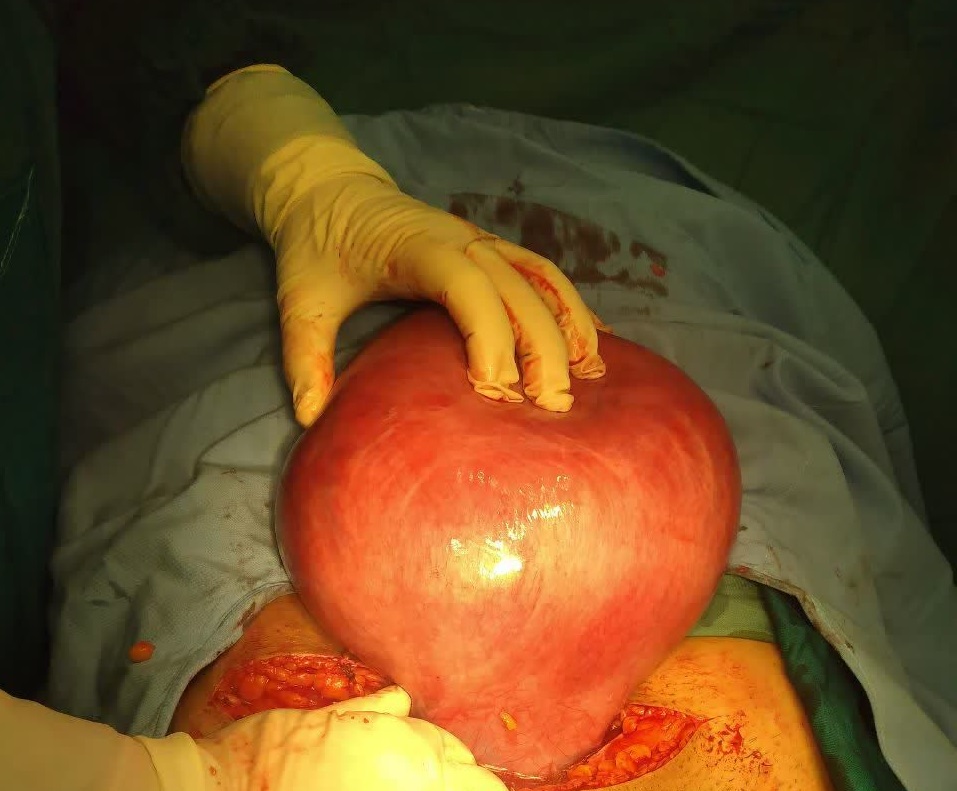 عمل جراحی موفق میومکتومی با حفظ باروری در بیمارستان خاتم‌الانبیاء (ص) گنبدکاووس