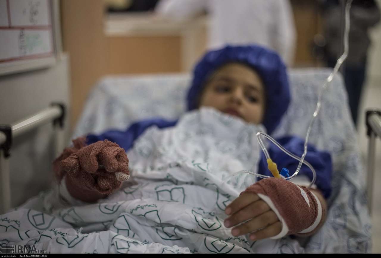 بحران سوختگی در ایران؛ کمبود ۱۵۰۰ تخت و هزینه‌های نجومی درمان