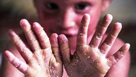 بیماران‌ پروانه‌ای؛ همچنان منتظر پاسخ بنیاد امور بیماری‌های خاص