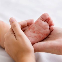 شیوع سرخک در بنگلادش اوج گرفت؛ شمار قربانیان رو به افزایش
