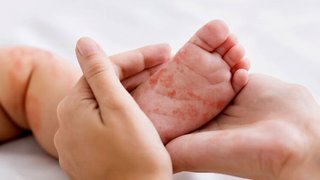 شیوع سرخک در بنگلادش اوج گرفت؛ شمار قربانیان رو به افزایش