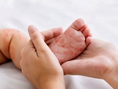 شیوع سرخک در بنگلادش اوج گرفت؛ شمار قربانیان رو به افزایش