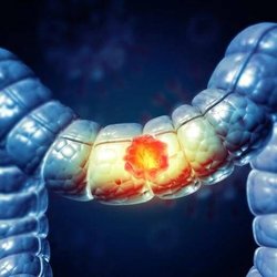 ترک الکل، سرطان روده را کاهش می‌دهد