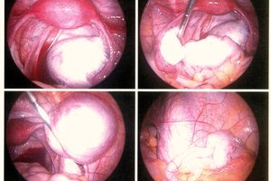 ابتلا به زگیل تناسلی به 17 سال رسید