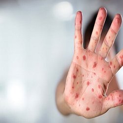 افزایش سه‌برابری موارد سرخک در استرالیا