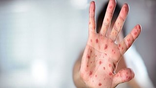 افزایش سه‌برابری موارد سرخک در استرالیا