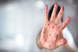 افزایش سه‌برابری موارد سرخک در استرالیا