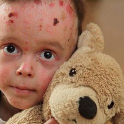 درخواست «خانه ای‌بی» از بنیاد بیماری‌های خاص: فهرست خدمات قابل ارایه به بیماران ای‌بی را اعلام کنید