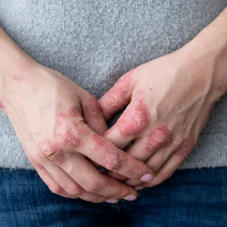 بدن‌هایی علیه خود؛ تشدید بیماری‌های خودایمنی در سایه اعتراضات و جنگ و گرانی