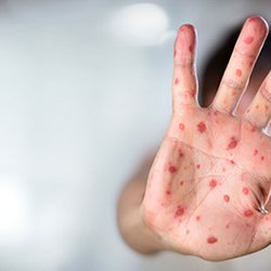 هشدار درباره افزایش موارد سرخک در ایران