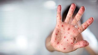 هشدار درباره افزایش موارد سرخک در ایران