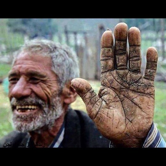 ترک‌های روی دست