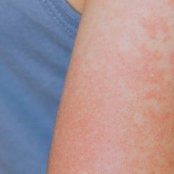 افزایش موارد ابتلا به سرخک در اروپا و آسیای مرکزی همزمان با افت واکسیناسیون