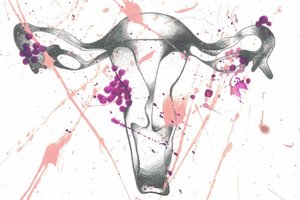 رنجی بالاتر از درد ماهانه