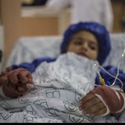 بحران سوختگی در ایران؛ کمبود ۱۵۰۰ تخت و هزینه‌های نجومی درمان