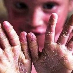 بیماران‌ پروانه‌ای؛ همچنان منتظر پاسخ بنیاد امور بیماری‌های خاص